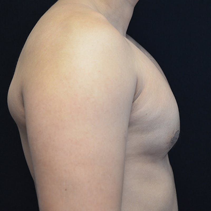 Gynecomastia Before & After Gallery - Patient 906159 - Image 6