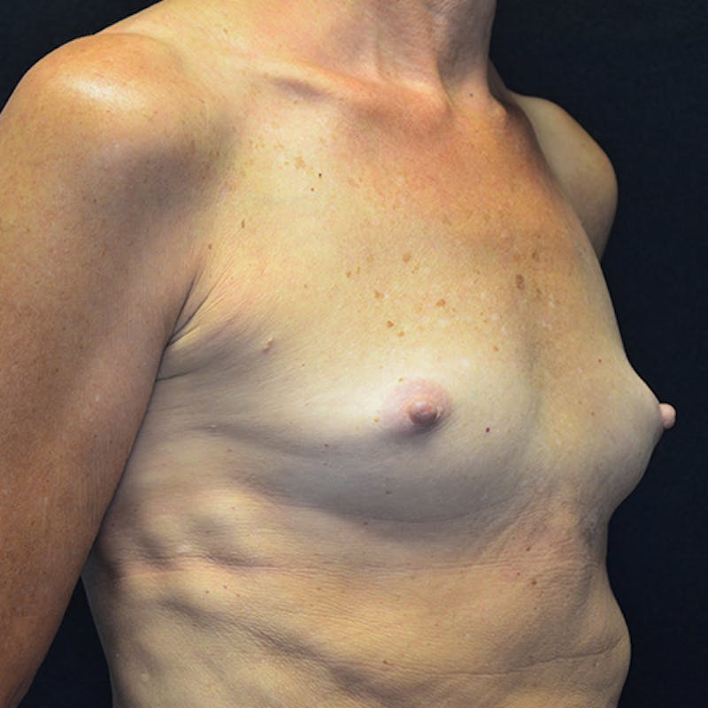 Breast Reconstruction Before & After Gallery - Patient 114721090 - Image 3