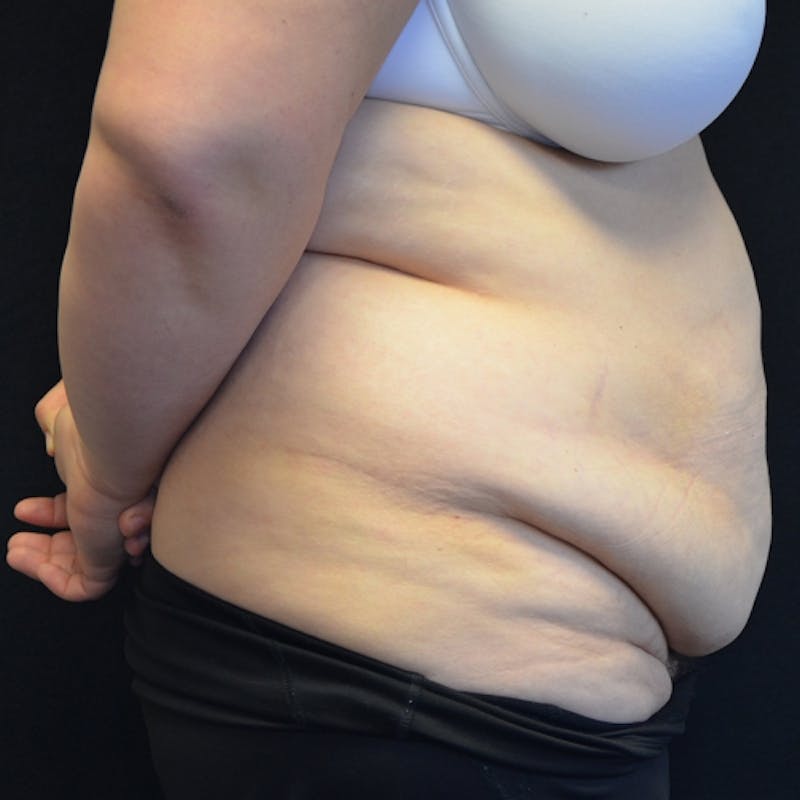 Fleur de lis Abdominoplasty Before & After Gallery - Patient 114721085 - Image 7