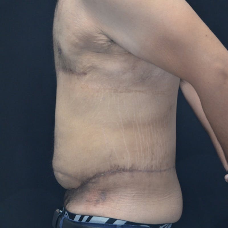 Body Lift Before & After Gallery - Patient 114721084 - Image 10