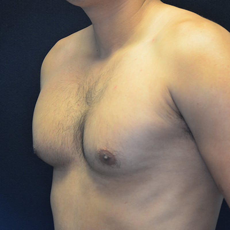 Gynecomastia Before & After Gallery - Patient 906159 - Image 7