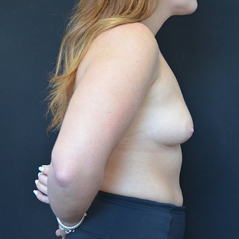 Breast Augmentation Before & After Gallery - Patient 114721091 - Image 5