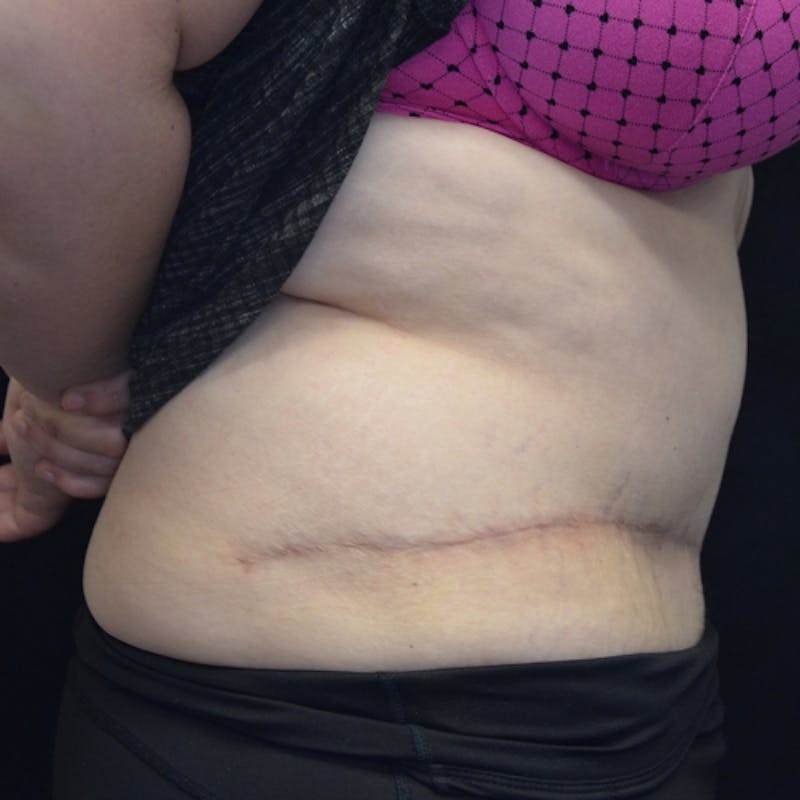 Fleur de lis Abdominoplasty Before & After Gallery - Patient 114721085 - Image 8