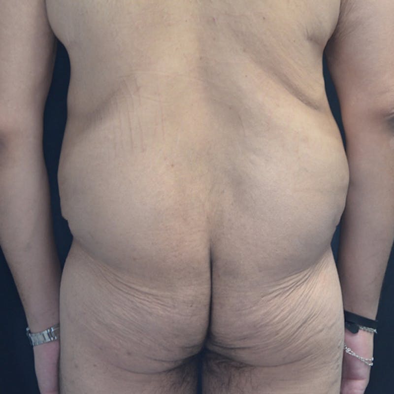 Body Lift Before & After Gallery - Patient 114721084 - Image 11