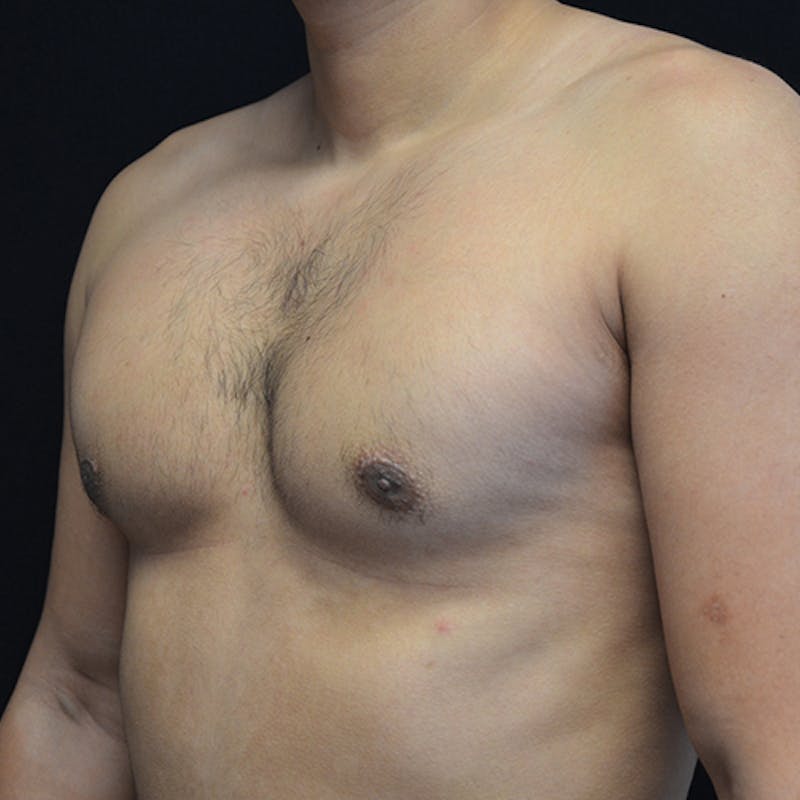 Gynecomastia Before & After Gallery - Patient 906159 - Image 8