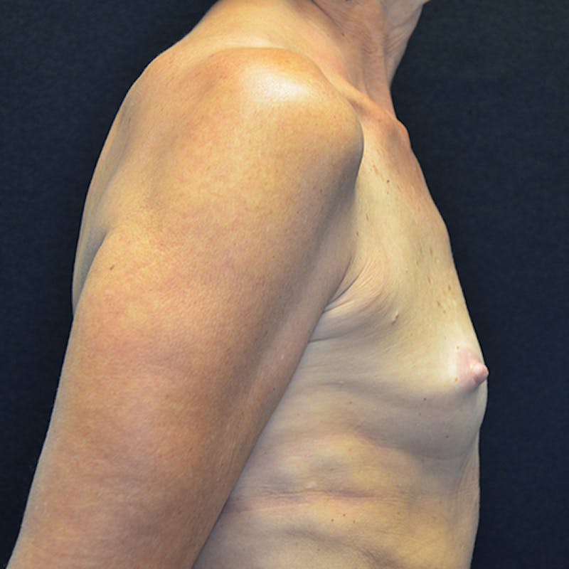 Breast Reconstruction Before & After Gallery - Patient 114721090 - Image 5
