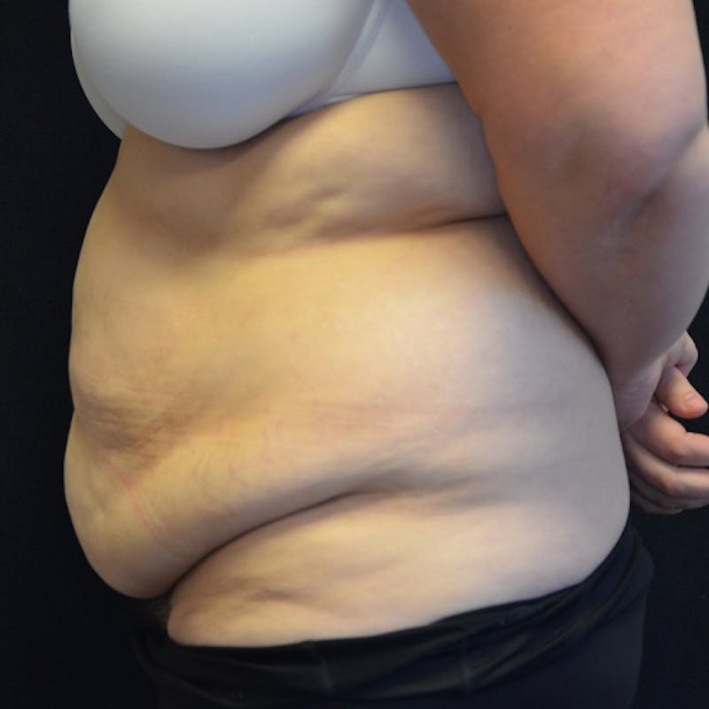 Fleur de lis Abdominoplasty Before & After Gallery - Patient 114721085 - Image 9