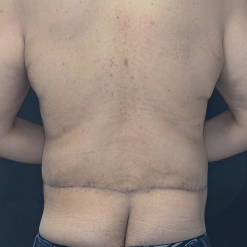 Body Lift Before & After Gallery - Patient 114721084 - Image 12