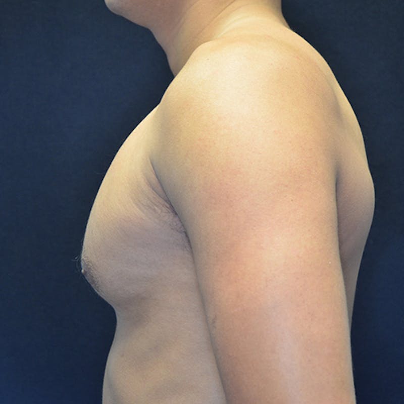 Gynecomastia Before & After Gallery - Patient 906159 - Image 9