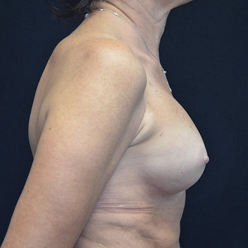 Breast Reconstruction Before & After Gallery - Patient 114721090 - Image 6