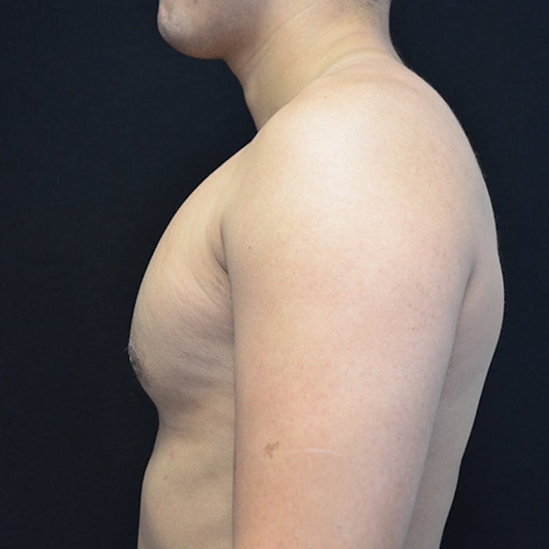 Gynecomastia Before & After Gallery - Patient 906159 - Image 10