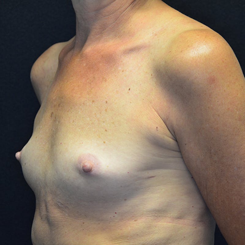 Breast Reconstruction Before & After Gallery - Patient 114721090 - Image 7