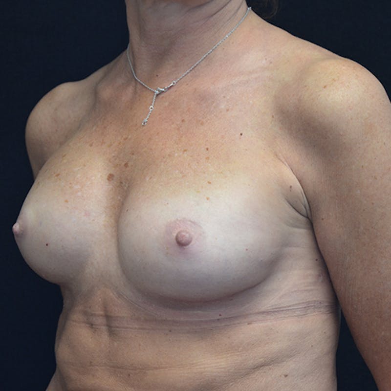 Breast Reconstruction Before & After Gallery - Patient 114721090 - Image 8