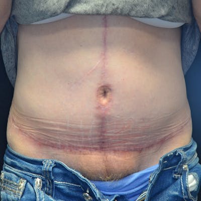 Fleur de lis Abdominoplasty Before & After Gallery - Patient 114721095 - Image 2