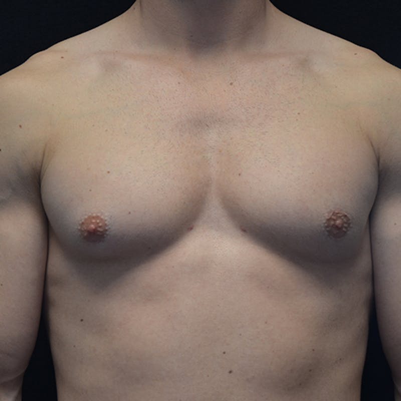 Gynecomastia Before & After Gallery - Patient 374492 - Image 1