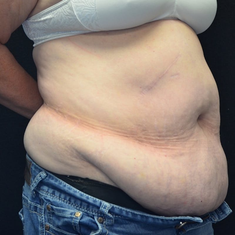 Fleur de lis Abdominoplasty Before & After Gallery - Patient 114721095 - Image 3