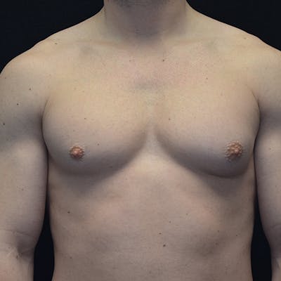 Gynecomastia Before & After Gallery - Patient 114721097 - Image 2
