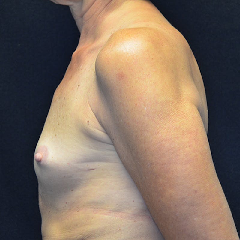 Breast Reconstruction Before & After Gallery - Patient 114721090 - Image 9
