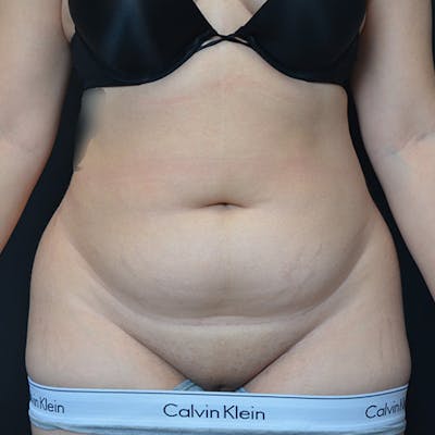 Liposuction Before & After Gallery - Patient 114721094 - Image 1