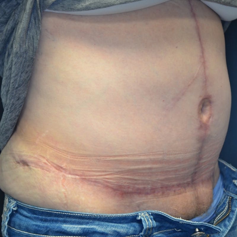 Fleur de lis Abdominoplasty Before & After Gallery - Patient 114721095 - Image 4