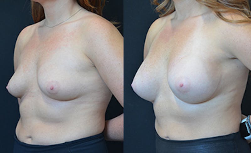 Breast Augmentation Before & After Gallery - Patient 114721091 - Image 11