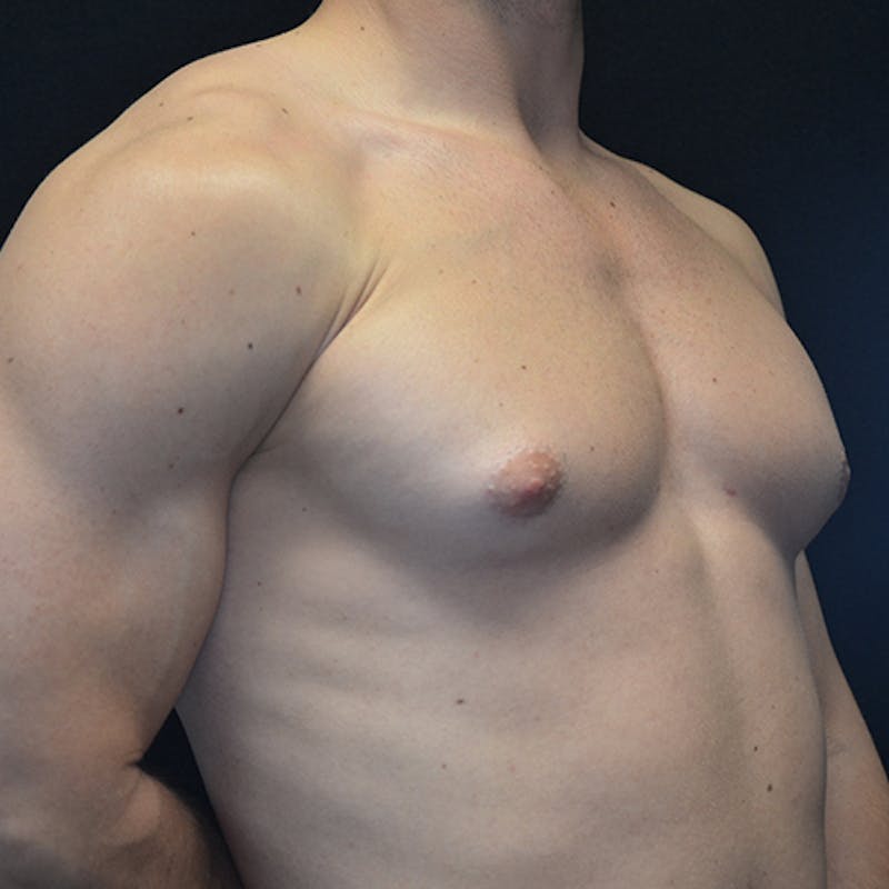 Gynecomastia Before & After Gallery - Patient 114721097 - Image 3