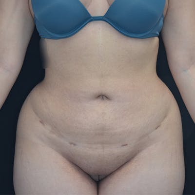 Liposuction Before & After Gallery - Patient 114721094 - Image 2