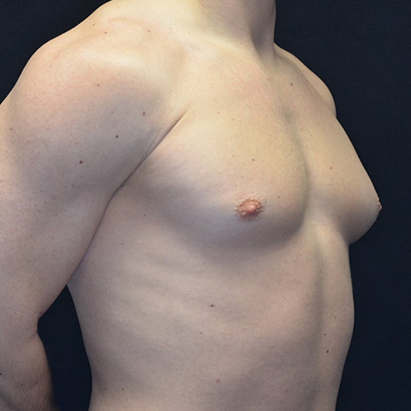 Gynecomastia Before & After Gallery - Patient 114721097 - Image 4