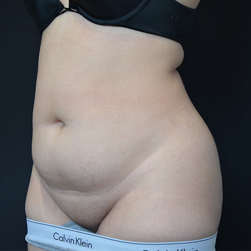 Liposuction Before & After Gallery - Patient 114721094 - Image 3