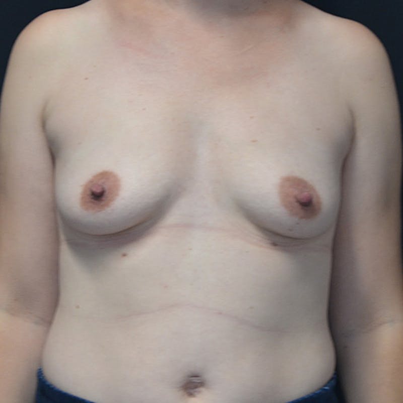 Breast Augmentation Before & After Gallery - Patient 114721099 - Image 1