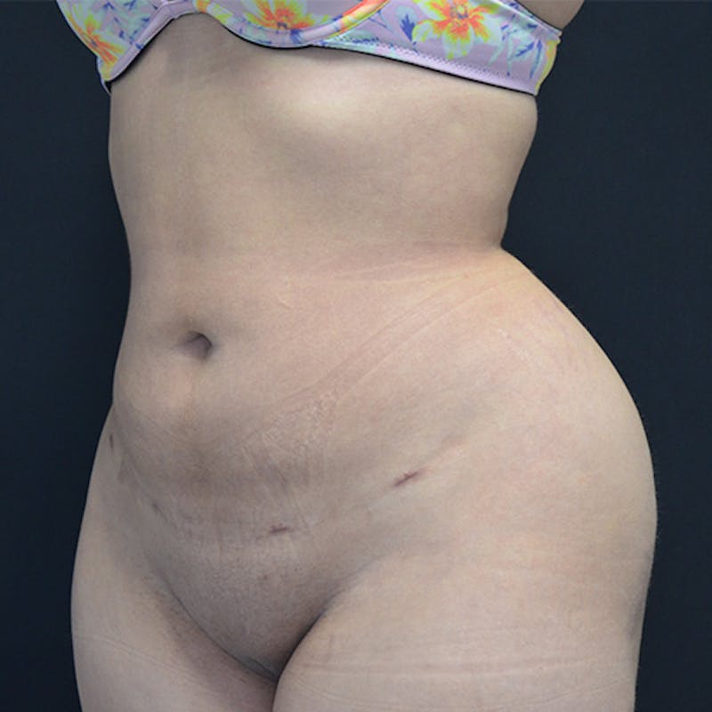 Liposuction Before & After Gallery - Patient 114721094 - Image 4