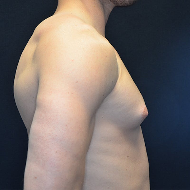 Gynecomastia Before & After Gallery - Patient 118184857 - Image 5