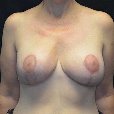 Breast Reconstruction Before & After Gallery - Patient 114721100 - Image 2