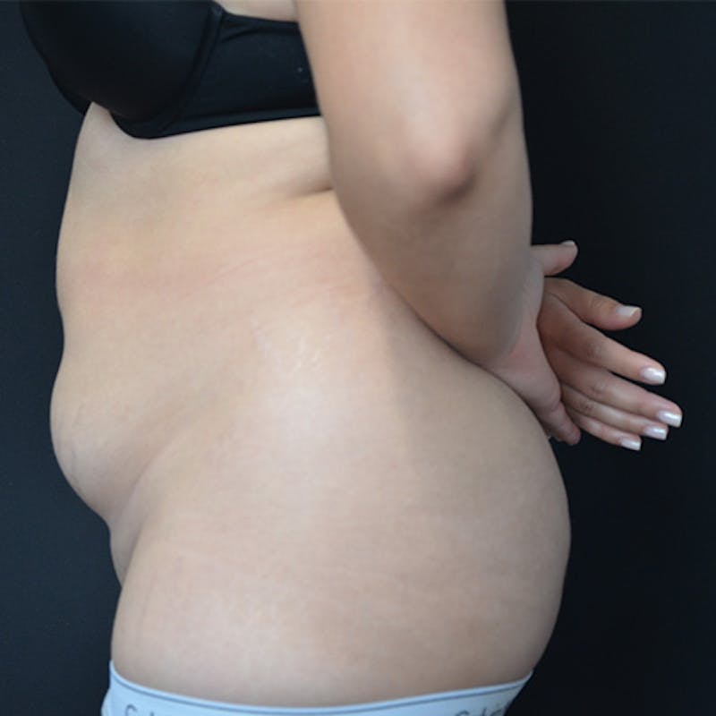 Liposuction Before & After Gallery - Patient 114721094 - Image 5