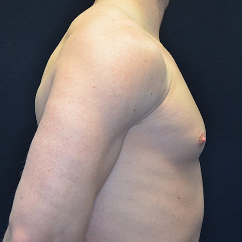 Gynecomastia Before & After Gallery - Patient 114721097 - Image 6