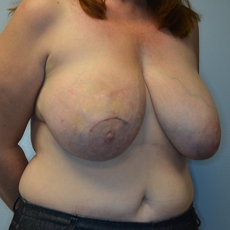 Breast Reconstruction Before & After Gallery - Patient 114721100 - Image 3