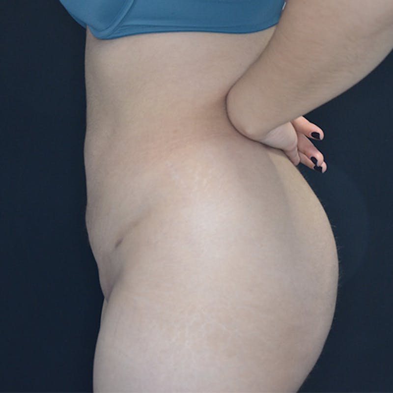 Liposuction Before & After Gallery - Patient 114721094 - Image 6