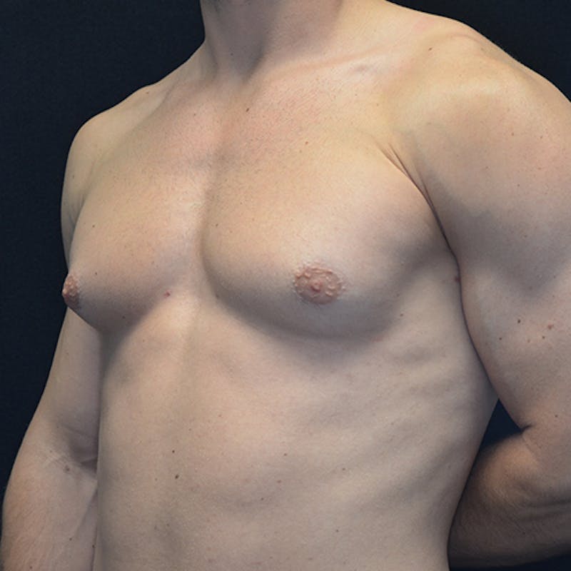Gynecomastia Before & After Gallery - Patient 114721097 - Image 7