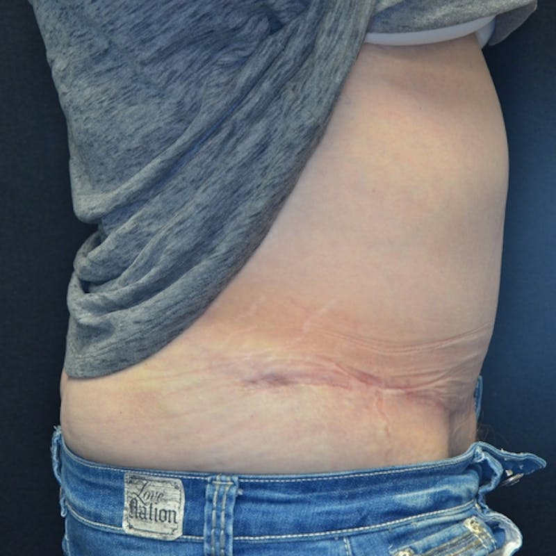 Fleur de lis Abdominoplasty Before & After Gallery - Patient 114721095 - Image 8