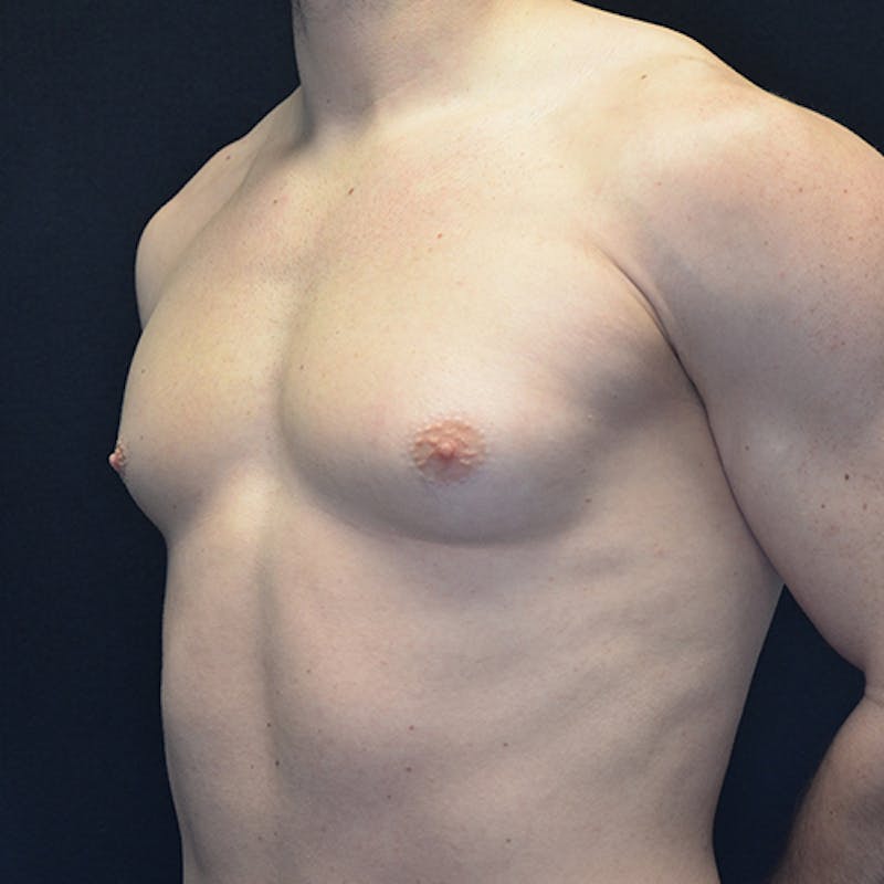 Gynecomastia Before & After Gallery - Patient 374492 - Image 8