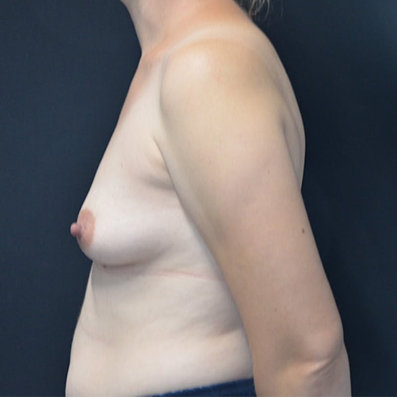 Breast Augmentation Before & After Gallery - Patient 114721099 - Image 5