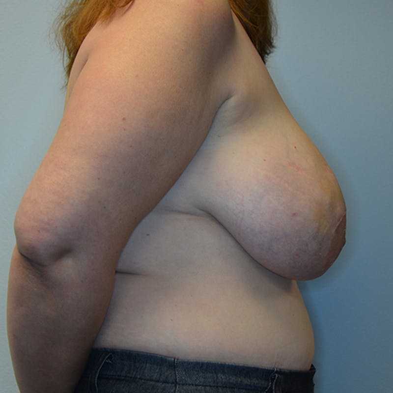 Breast Reconstruction Before & After Gallery - Patient 114721100 - Image 5