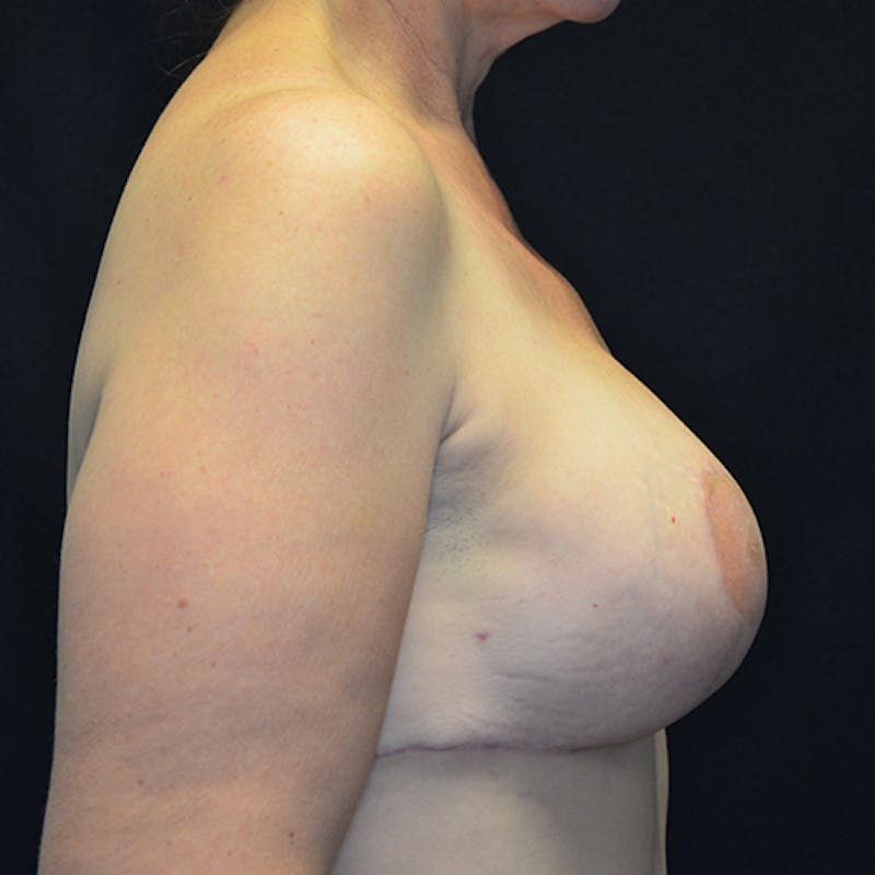 Breast Reconstruction Before & After Gallery - Patient 114721100 - Image 6