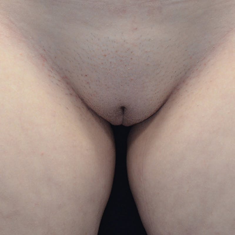 Labiaplasty Before & After Gallery - Patient 114721096 - Image 4
