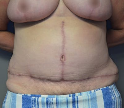 Fleur de lis Abdominoplasty Before & After Gallery - Patient 114721103 - Image 2