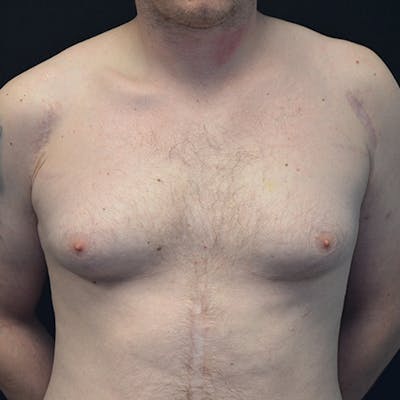 Gynecomastia Before & After Gallery - Patient 133543 - Image 1
