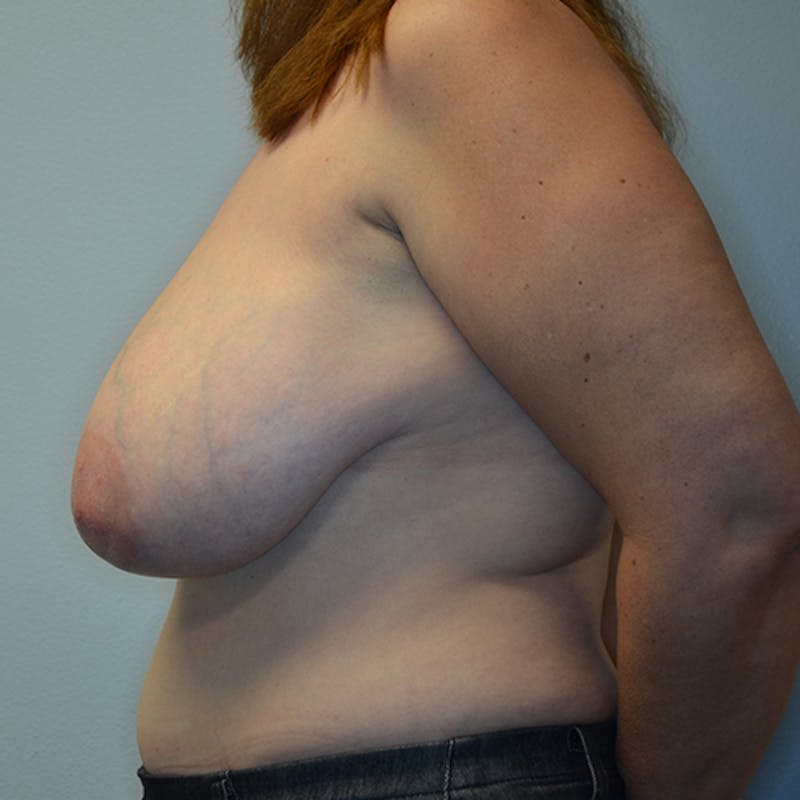 Breast Reconstruction Before & After Gallery - Patient 114721100 - Image 9