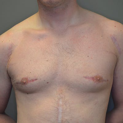 Gynecomastia Before & After Gallery - Patient 133543 - Image 2