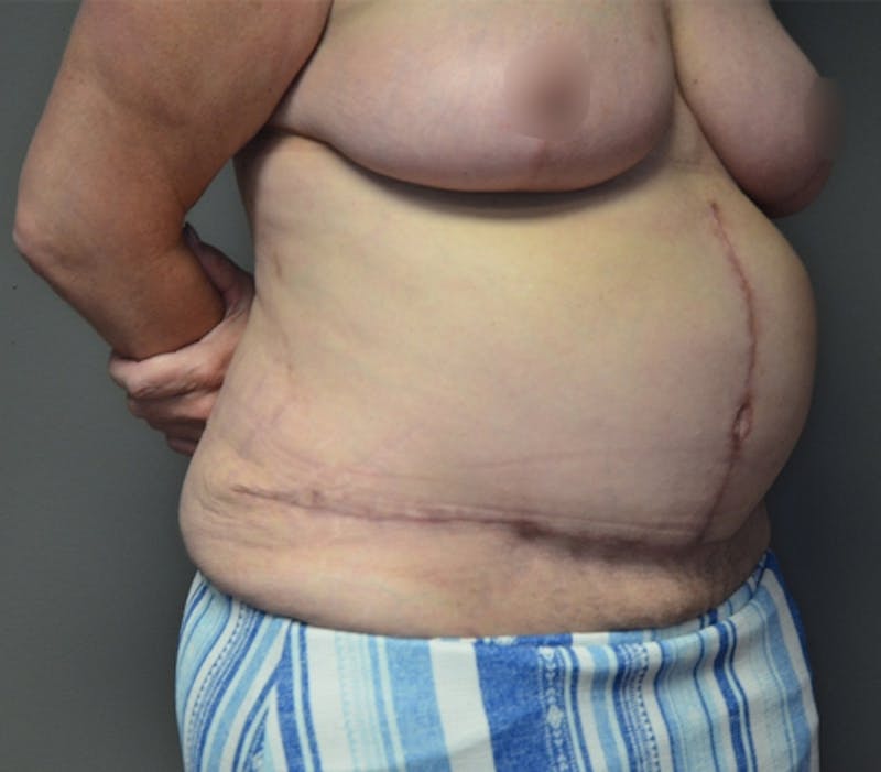 Fleur de lis Abdominoplasty Before & After Gallery - Patient 114721103 - Image 4