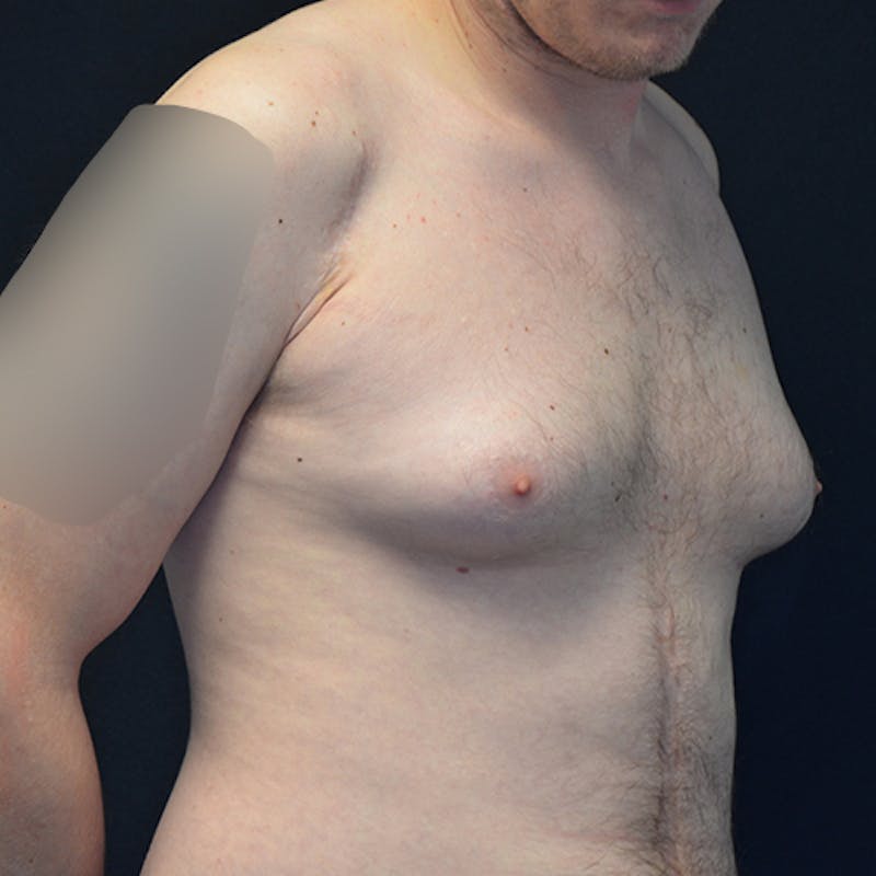 Gynecomastia Before & After Gallery - Patient 118184866 - Image 3